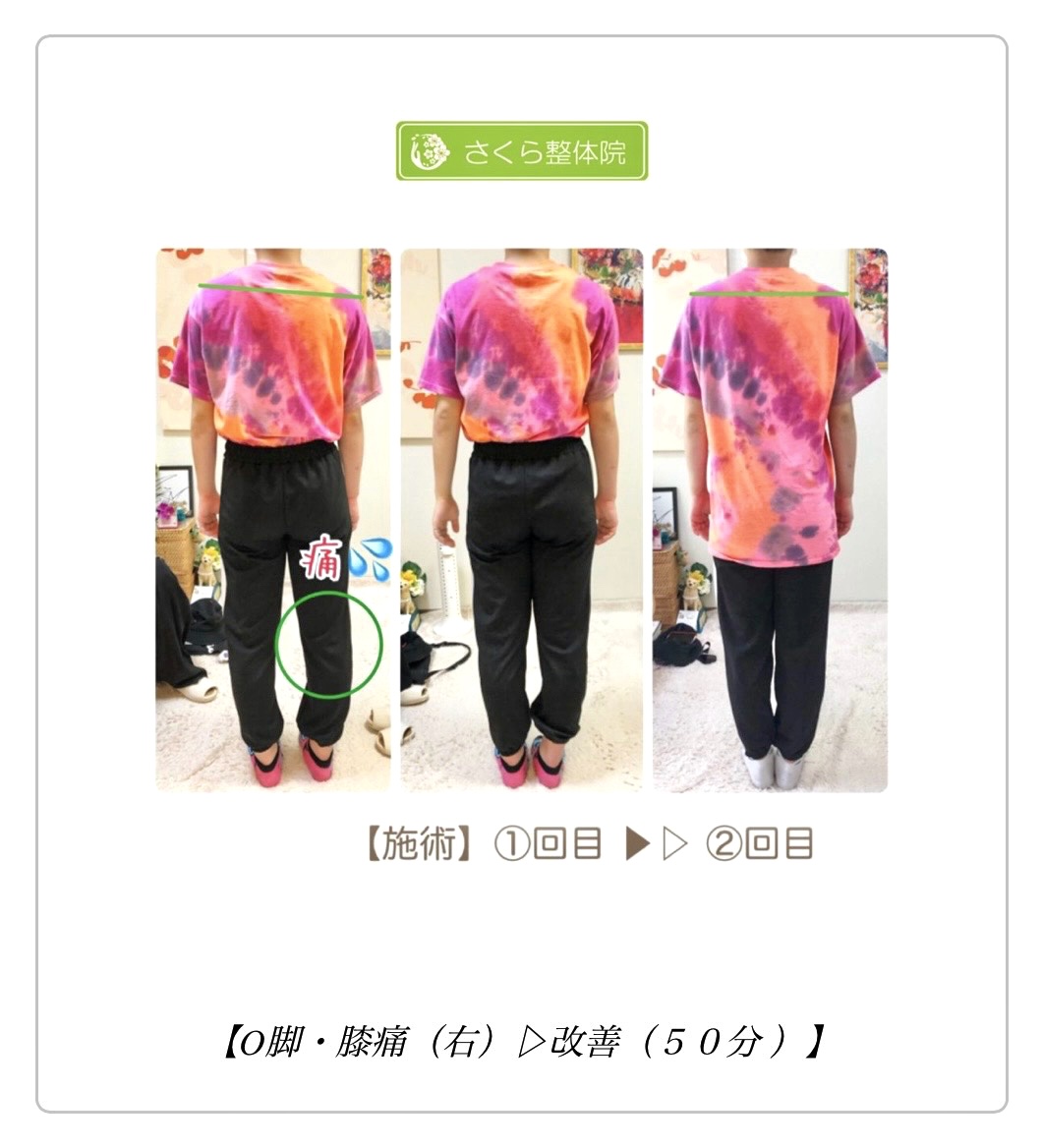 奈良市 O脚矯正