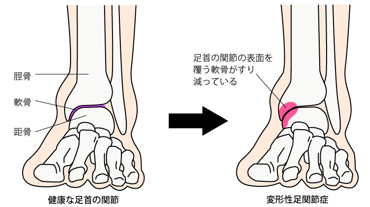 奈良市変形性足関節症
