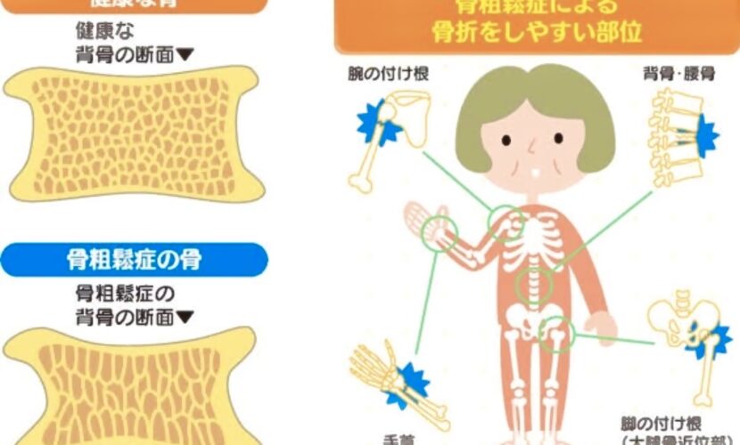 奈良市骨粗鬆症