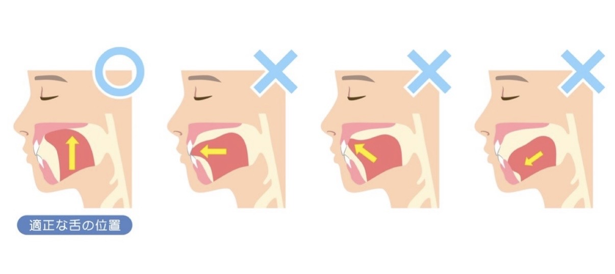 舌の正しい位置スポットポジションの図